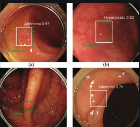 phan-tang-nguy-co-benh-nhan-de-tranh-bo-sot-polyp-dai-truc-trang-va-vai-tro-cua-tri-tue-nhan-tao-1